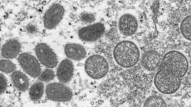 Affenpocken-Virus verbreitet sich rasant